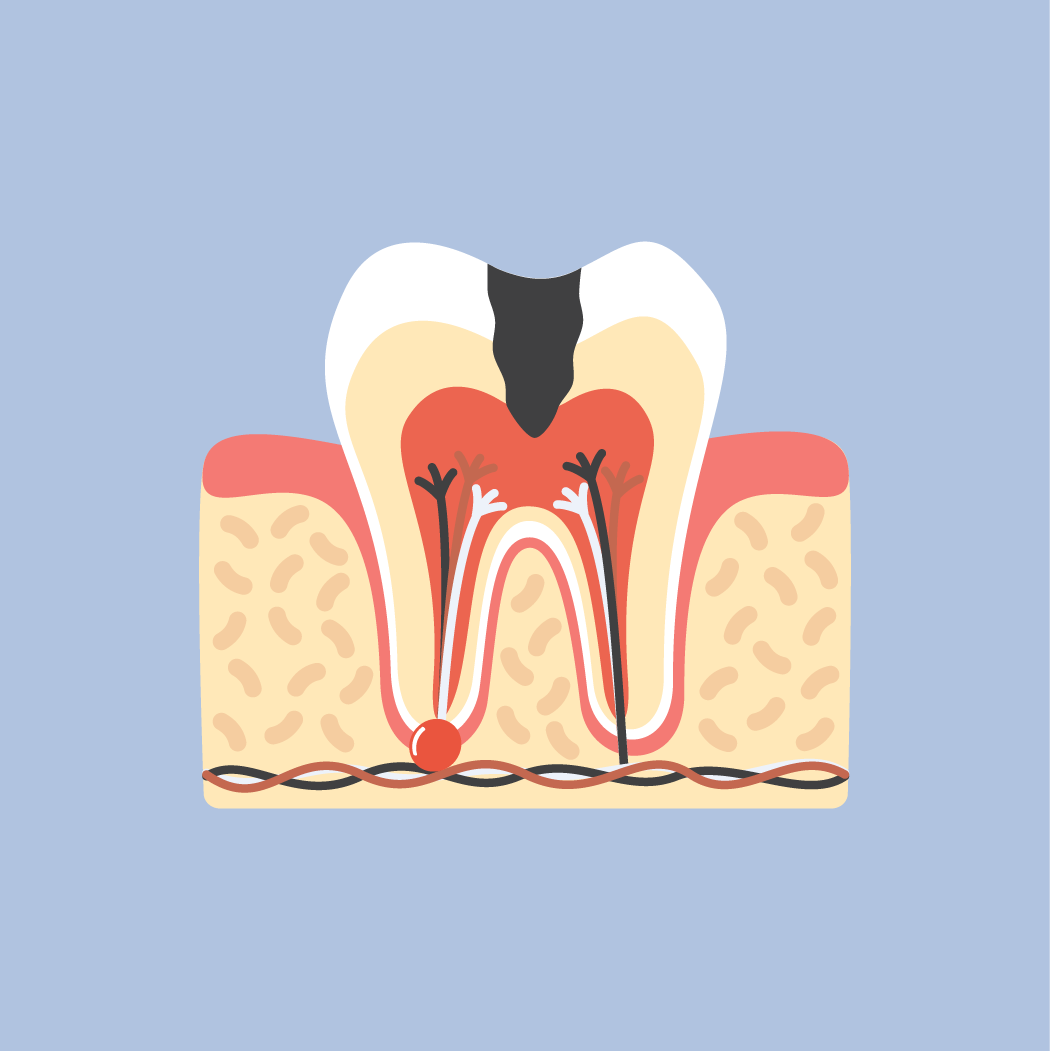 Severe tooth decay icon