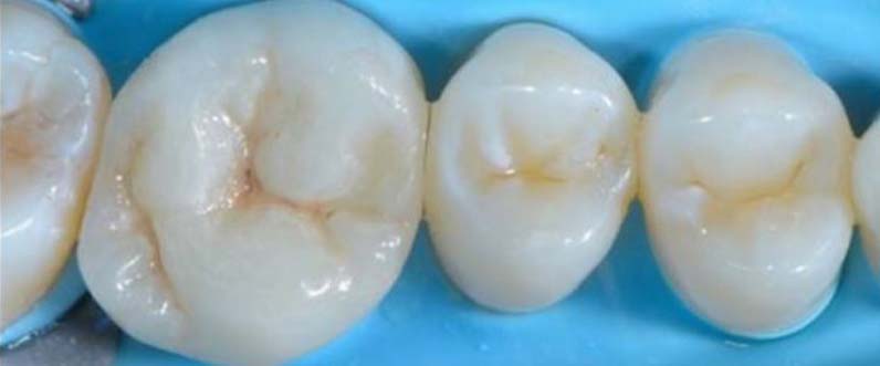 Tooth restoration with crowns