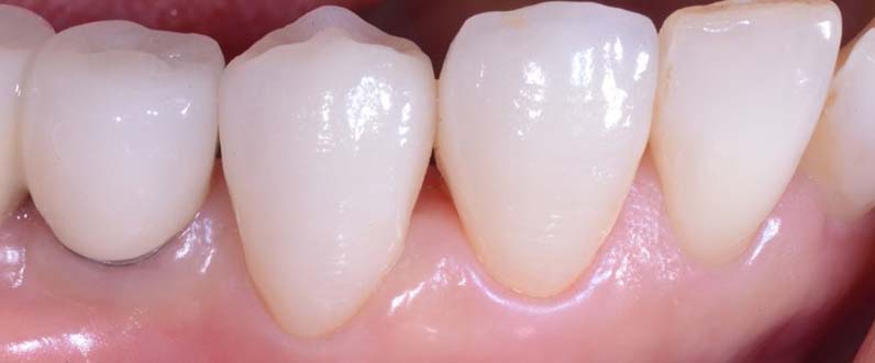 recurrent tooth decay after