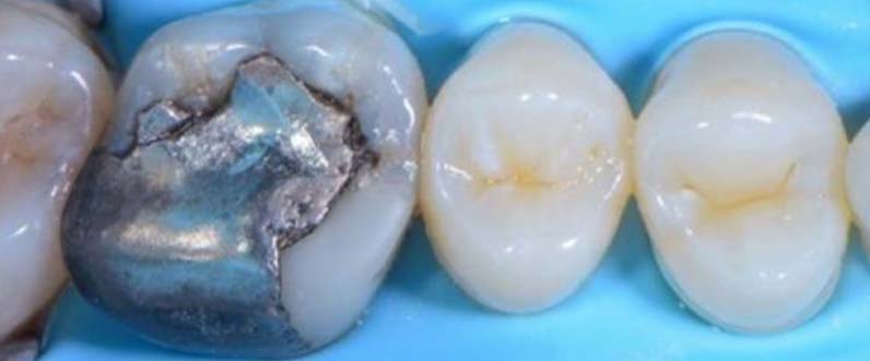 Tooth restoration with crown