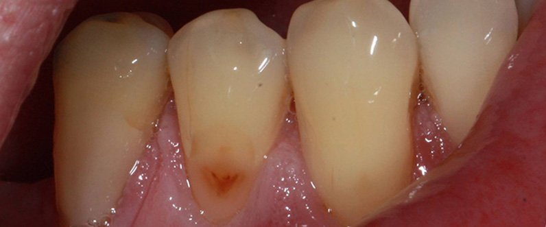 Tooth resin restoration before