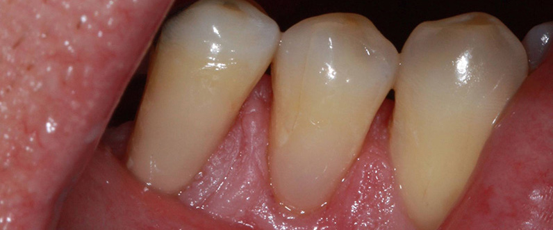Tooth resin restoration after