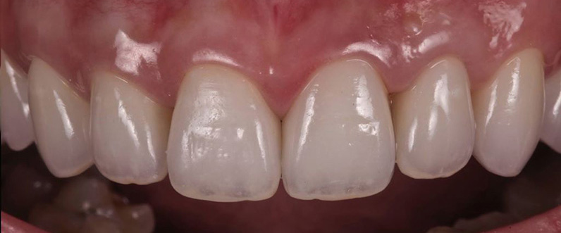 Restorative dentistry after front crowns