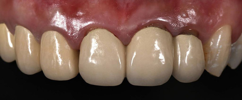 Restorative dentistry before crowns