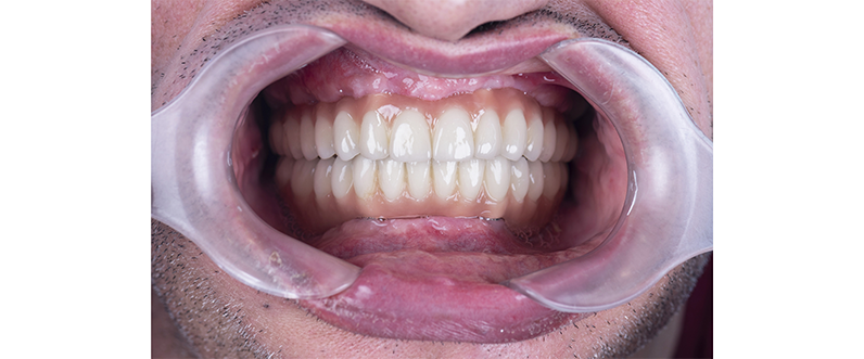 Full mouth dental reconstruction