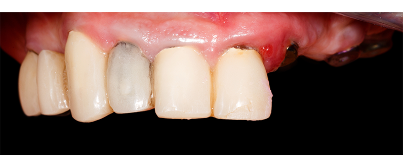 Decayed teeth restoration